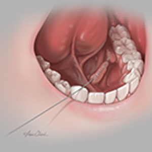 COOK Sialendoscopy