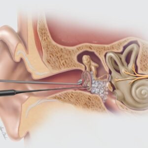Biodesign® Otologic Repair Graft