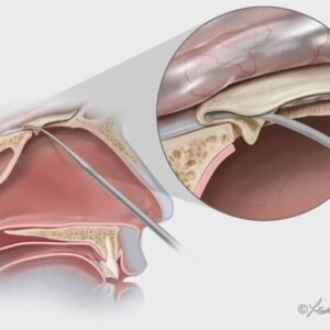 Biodesign® Duraplasty Graft